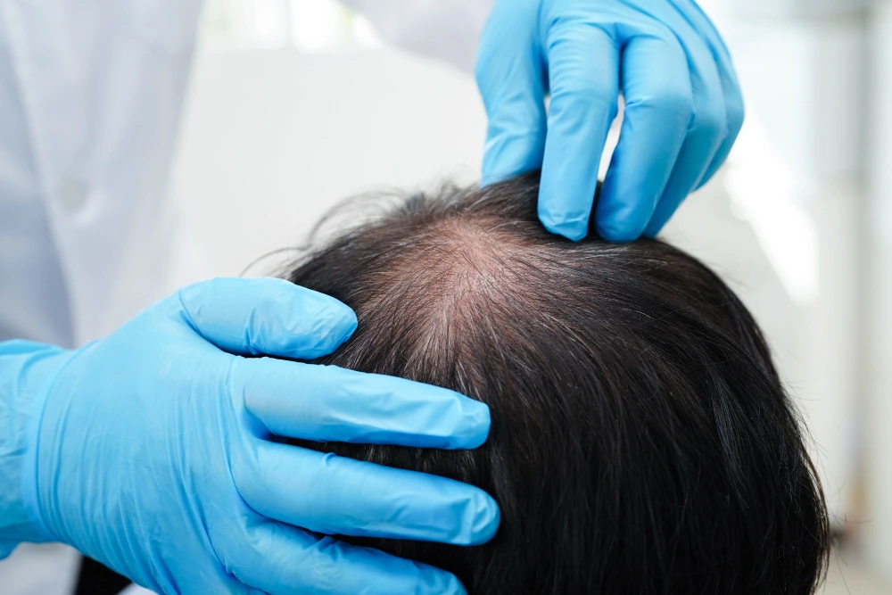 alopecia areata hair loss patches